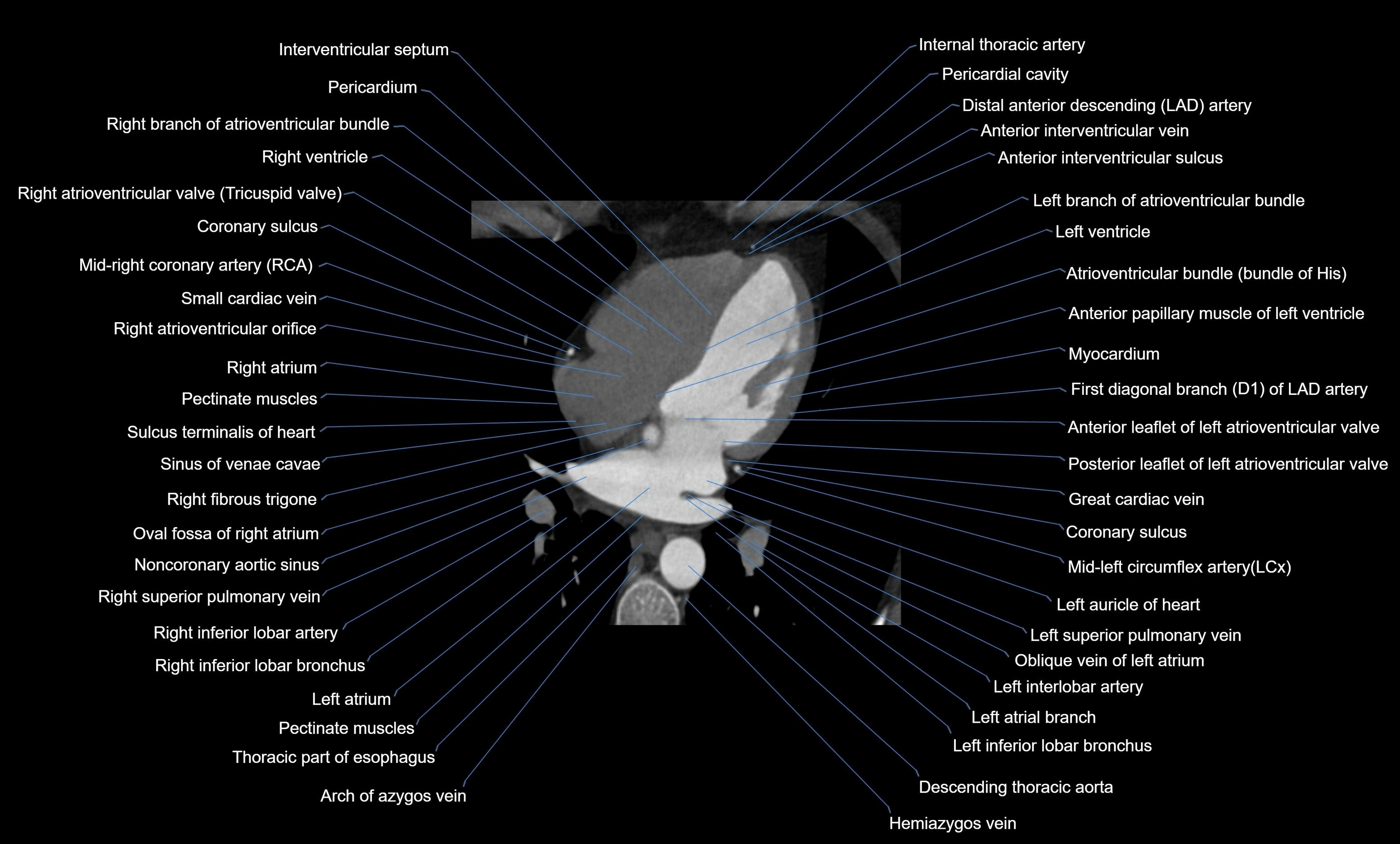 CT heart (coronary angiogram) four chamber view  cross sectional anatomy labelled radiology image -00028.webp